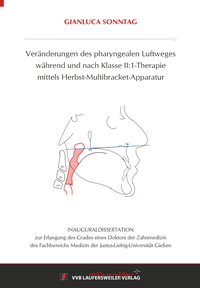 Veränderungen des pharyngealen Luftweges während und nach Klasse II:1-Therapie mittels Herbst-Multibracket-Apparatur