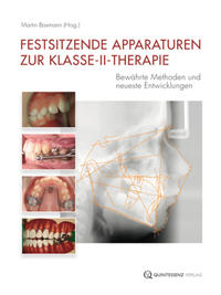 Festsitzende Apparaturen zur Klasse-II-Therapie