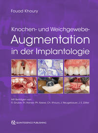 Knochen- und Weichgewebeaugmentation in der Implantologie