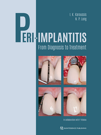 Peri-Implantitis